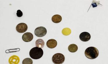 Фото Батарейки, монеты и скрепки извлек из детей врач из Магнитогорска 